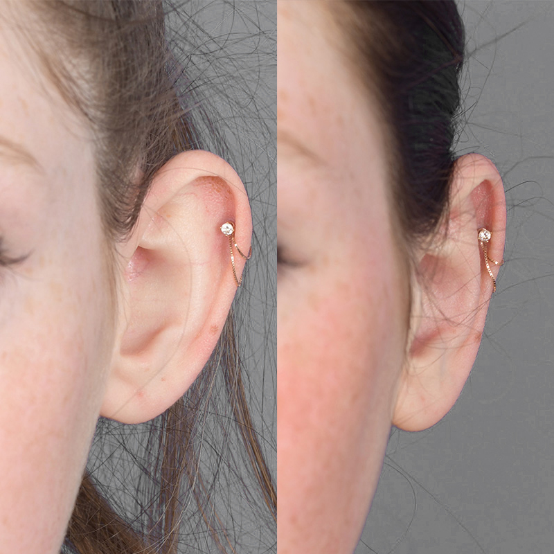 Otoplasty